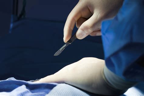 Surgical excision process