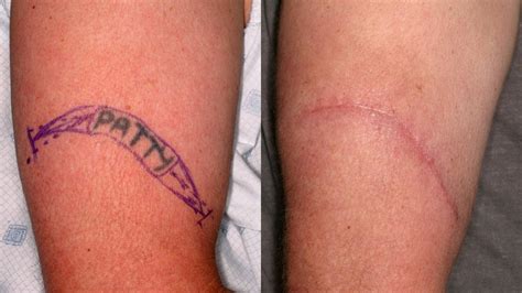 Surgical excision tattoo removal