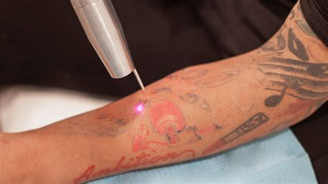 Tattoo ink removal