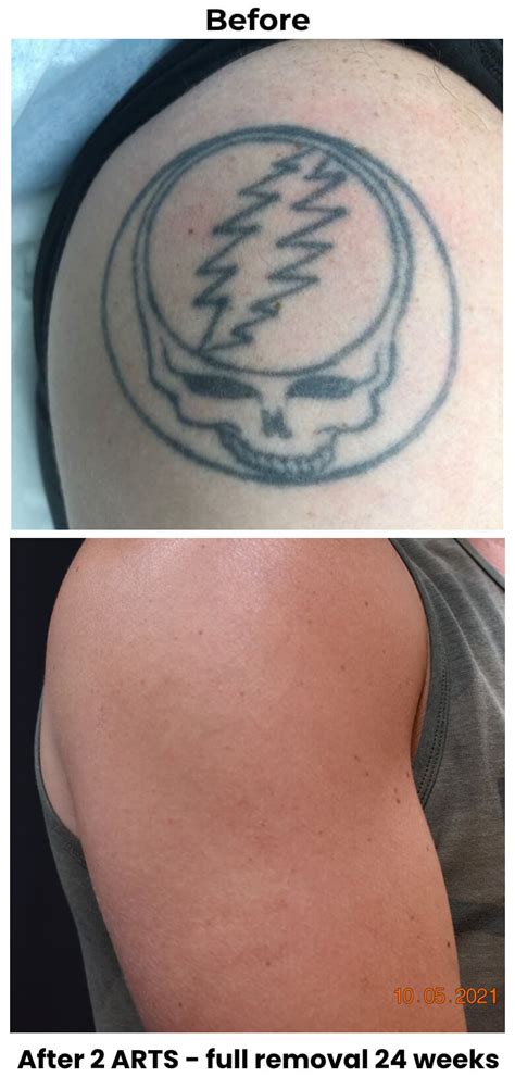 Tattoo removal and cover-up options in Greenville SC