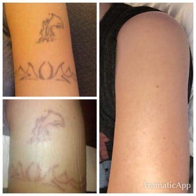 Tattoo Removal