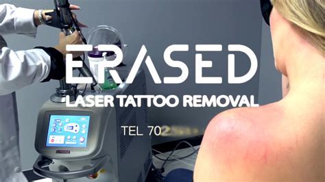 Tattoo removal and correction