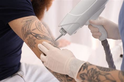 Tattoo removal advice