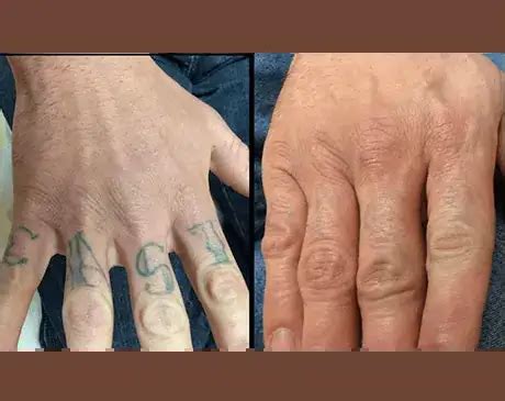 Tattoo removal Albuquerque reviews