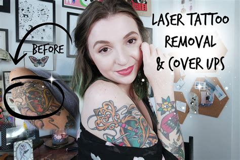 Tattoo Removal and Cover-Ups