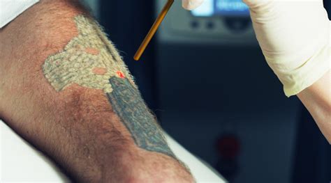 Tattoo removal in Baltimore