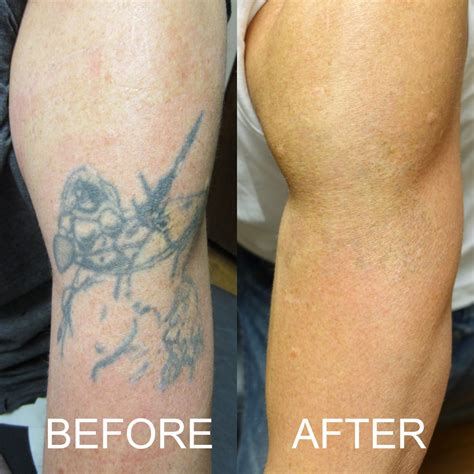 Tattoo removal before and after