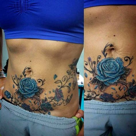 Tattoo Removal Before Tummy Tuck Example 4