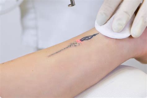 Tattoo removal clinic