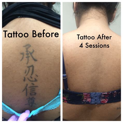 Tattoo Removal Cost