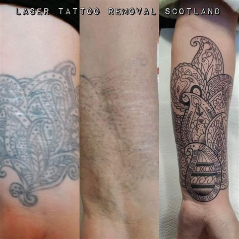 Tattoo Removal Edinburgh