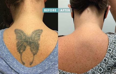 Tattoo removal experts in Nashville