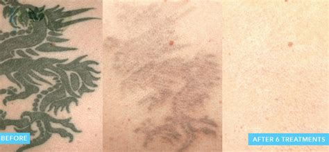 Tattoo removal in Greensboro, NC