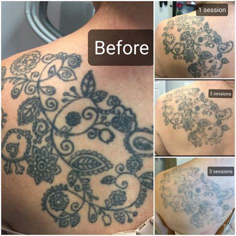 Tattoo removal process