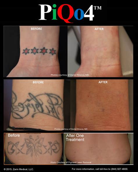 Tattoo removal pain