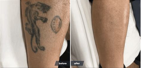 Tattoo removal recovery process