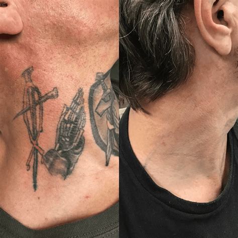 Tattoo removal results