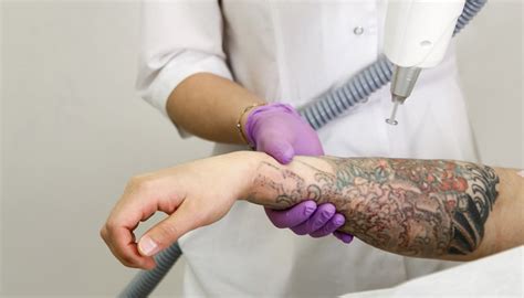 Professional Tattoo Removal Service