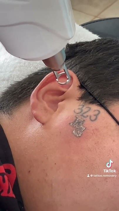 Tattoo Removal Tijuana