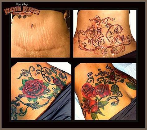 Tattoos and Abdominoplasty Example 6