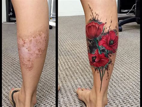 Tattoos to cover scar tissue