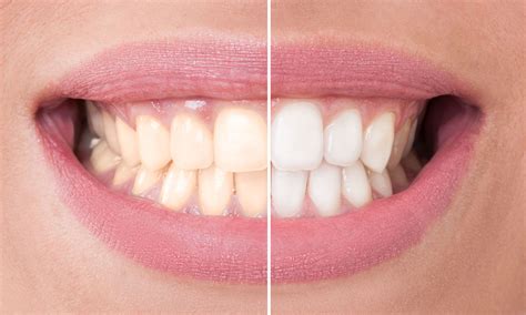 teeth whitening cost