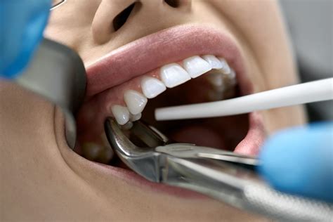 Tooth Extraction