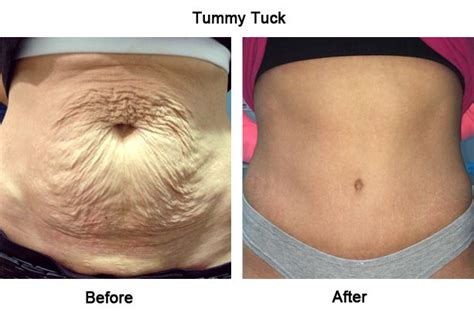 Before and After Photos of Tummy Tuck