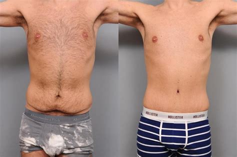 Results of Tummy Tuck Surgery