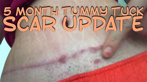 Scarring After Tummy Tuck