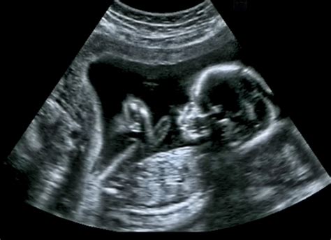 Ultrasound Image