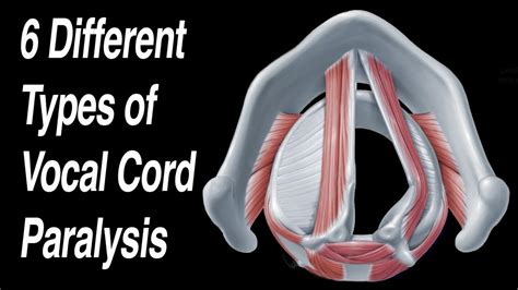 Vocal Cord Paralysis