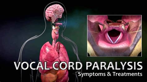 Vocal Cord Paralysis Image 1