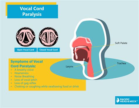 Vocal Cord Paralysis Symptoms