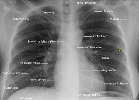 X-ray markings in military operations